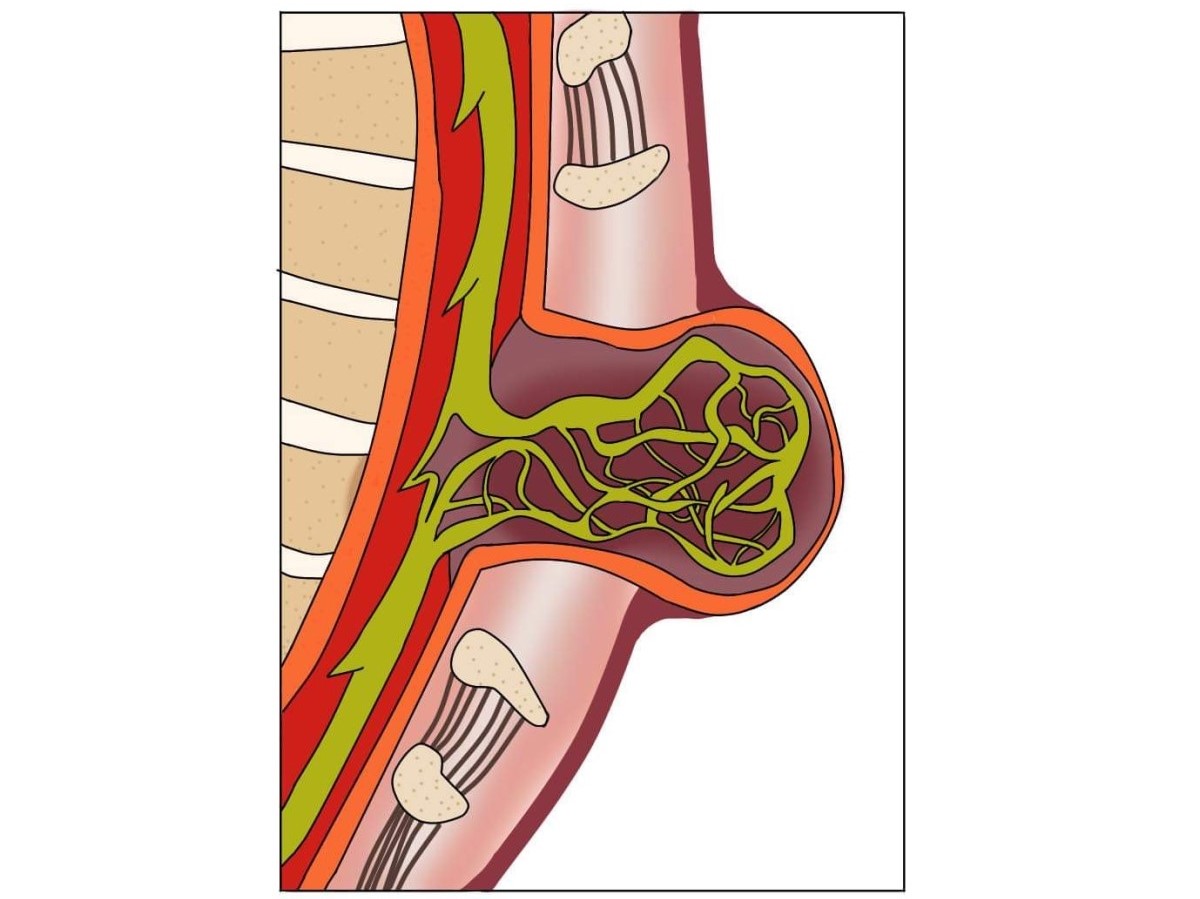 Mielomeningocele, una spina bifida aperta con spostamento del midollo spinale e dei nervi spinali.